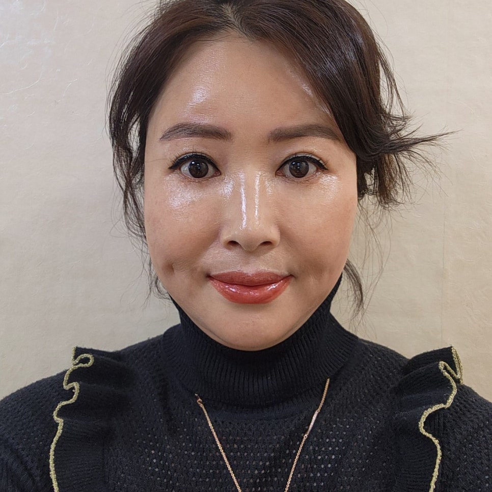 눈밑처짐수술전후 눈밑 흉터 걱정 없었어요 관련 이미지 1