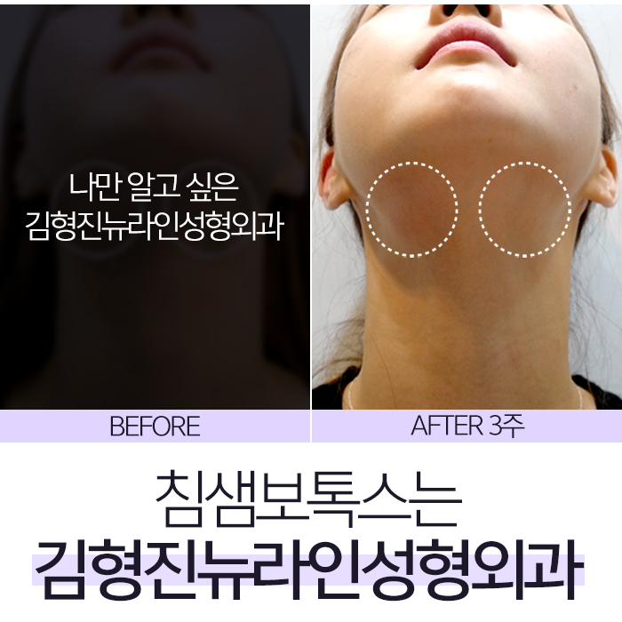 침샘보톡스 신중한 선택은 김형진원장 관련 이미지 5