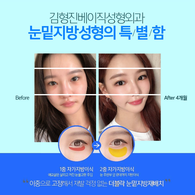 가장 빠르게 눈밑주름없애는방법 아직도 모르겠다면 관련 이미지 5