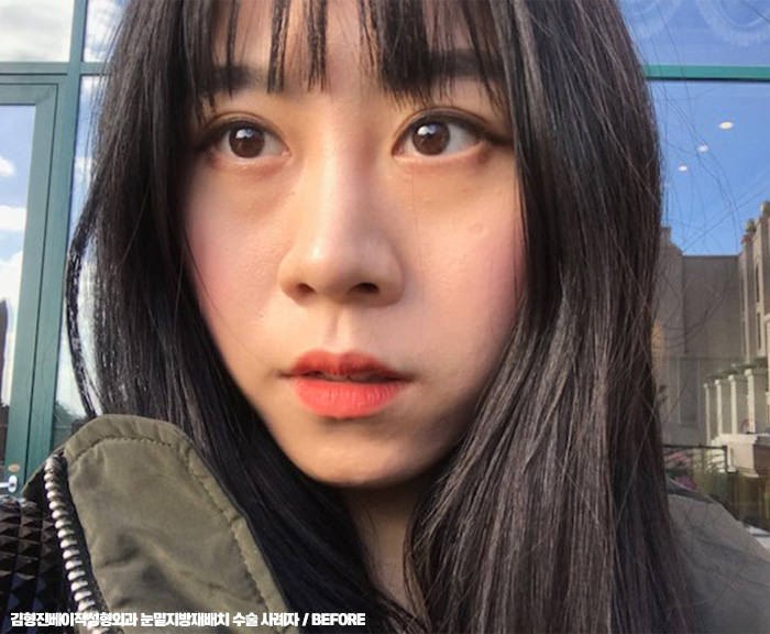 눈밑지방재배치후기 봐줄거죠? 관련 이미지 1