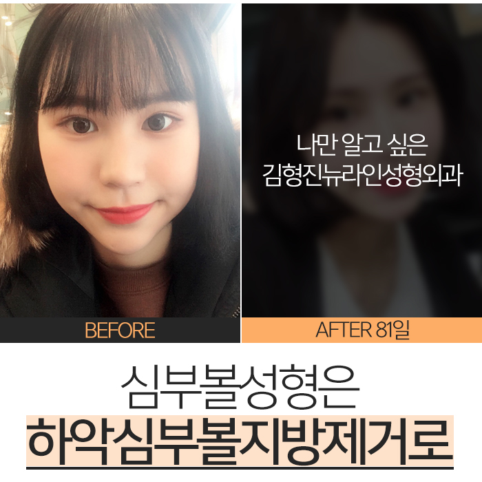 심부볼성형 능력자 김형진원장님! 관련 이미지 2