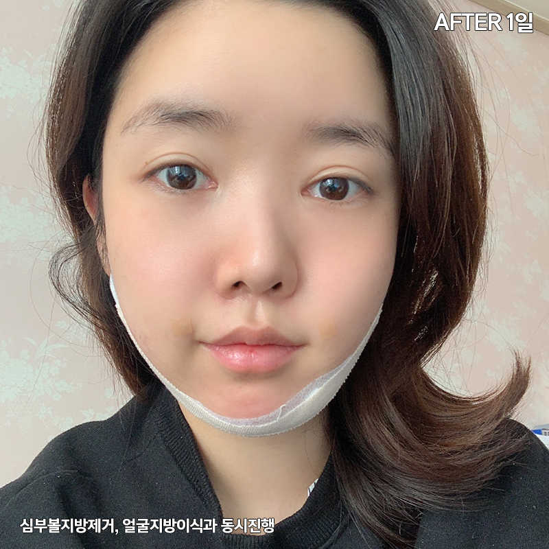 턱지방흡입 처짐 없는 김형진베이직 관련 이미지 3
