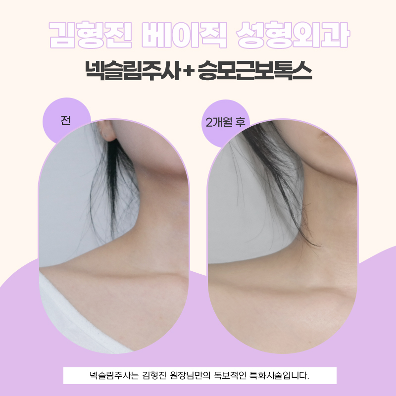 역대급 넥슬림주사전후 차이 궁금하다면 관련 이미지 5