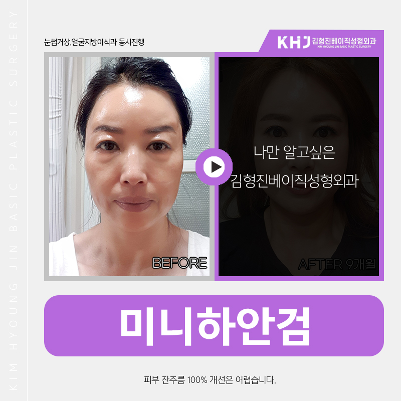 미니하안검병원 자연스럽게 잘해주는곳 찾고있다면 관련 이미지 4