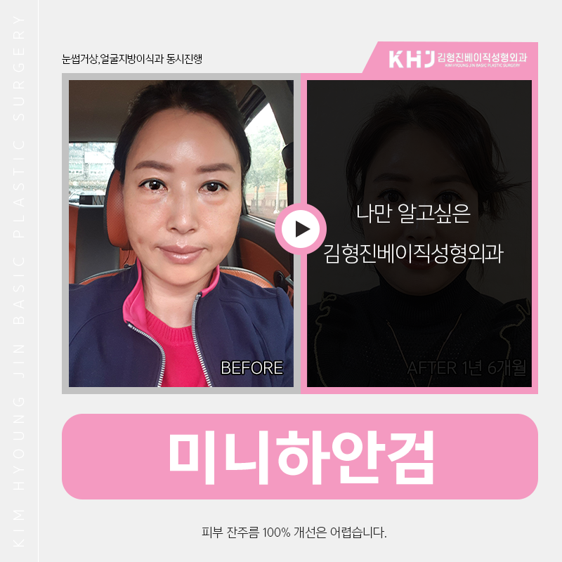 미니하안검흉터 고민은 이제 그만! 관련 이미지 4