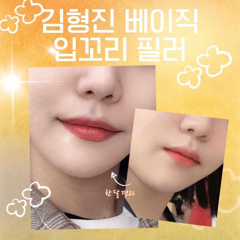 입꼬리필러전후 이보다 다를 수가 있나요? 관련 이미지 4