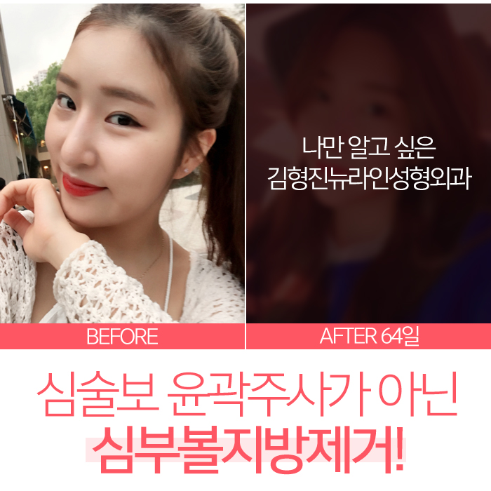 심술보윤곽주사 어림 없어요!! 관련 이미지 3