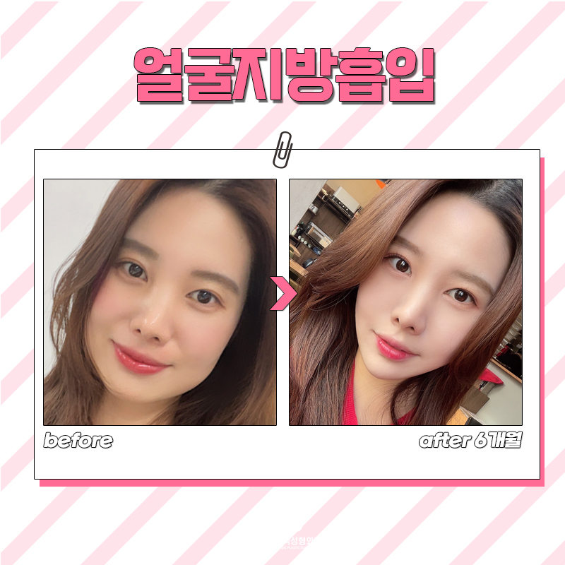 후덕한 얼굴살제거 가장 빨리 해결할 수 있는 방법! 관련 이미지 6