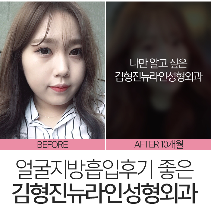 얼굴지방흡입후기 완벽 변신! 관련 이미지 8