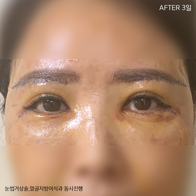 미니하안검회복과정 한 눈에 확인! 관련 이미지 3