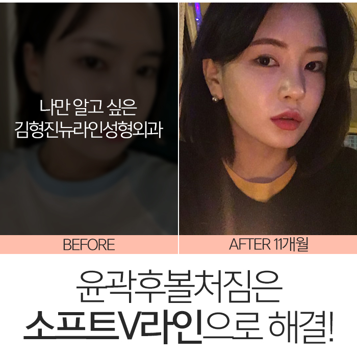 윤곽후볼처짐 해결하려면 관련 이미지 8