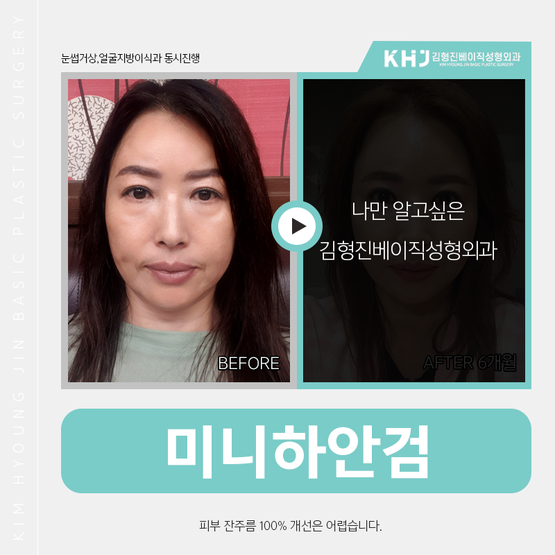 미니하안검효과 얼마나 좋냐면요 관련 이미지 4