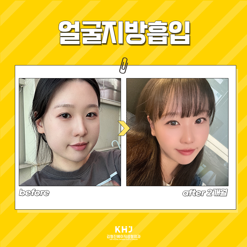 얼굴살없애는법 확실하게 해결하고 싶다면 관련 이미지 5