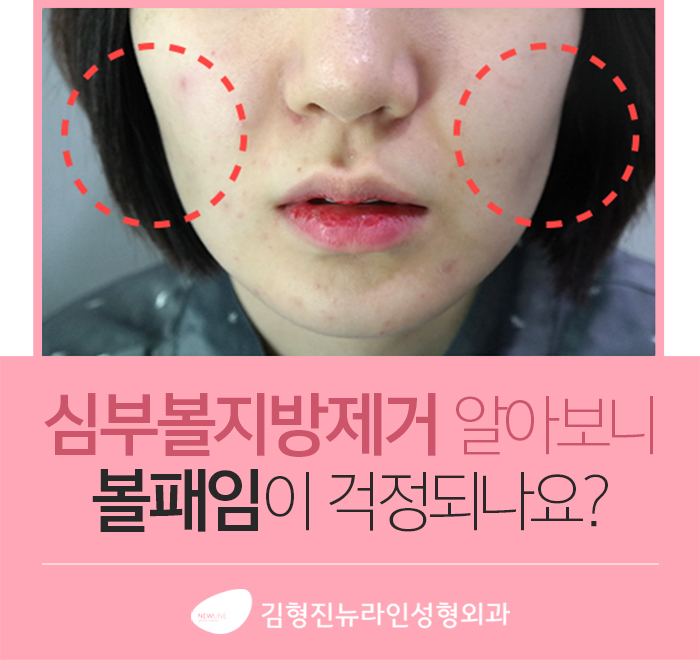 하악심부볼지방제거 안전과 부작용을 생각한다면 관련 이미지 2