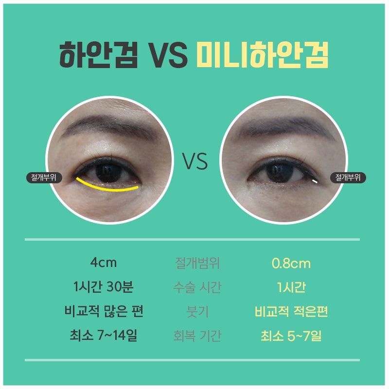 아직도 중년눈밑수술 잘 모르겠다면 관련 이미지 4