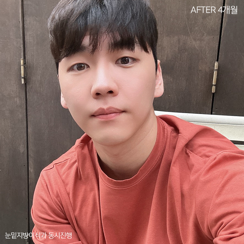 눈밑지방재배치잘하는병원 김형진베이직! 관련 이미지 5
