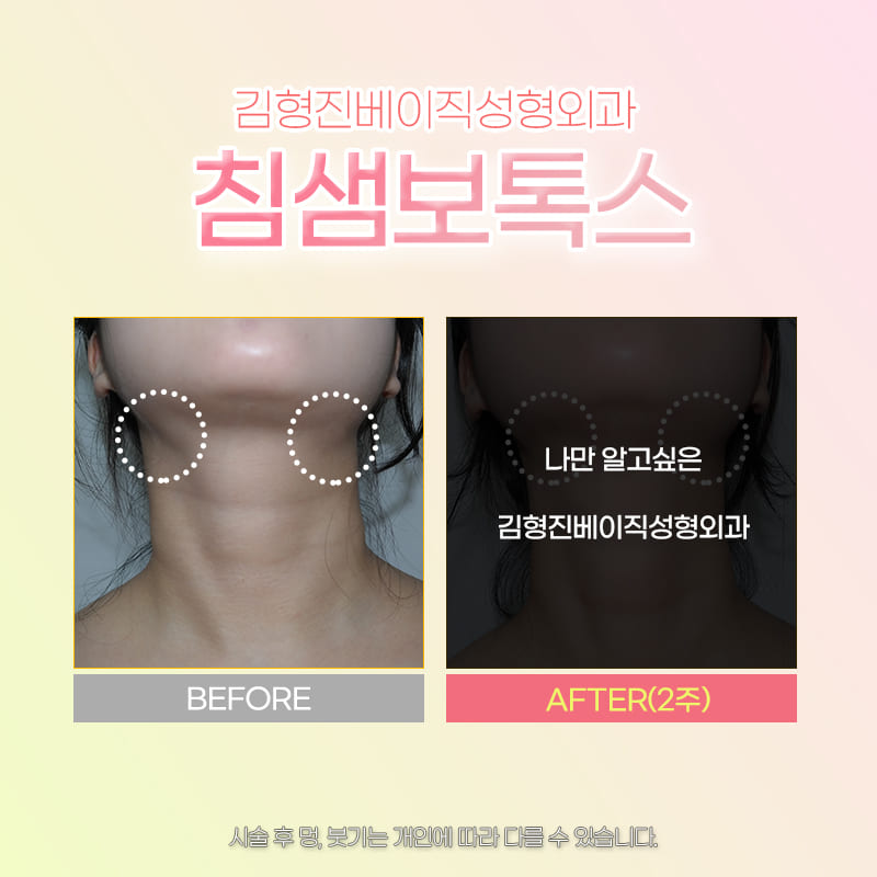 역대급 강남침샘보톡스후기! 이보다 확실할 수는 없어요 관련 이미지 5