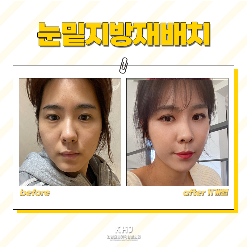 재발 없는 눈밑지방재배치병원 찾고있다면 관련 이미지 5