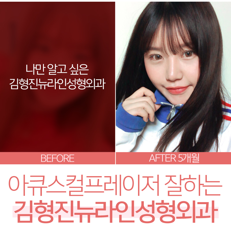 아큐스컬프레이저 어쩜 붓기가 없어? 관련 이미지 6