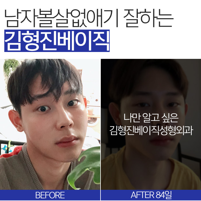 남자볼살없애기 실패한 이유, 아직 몰라요? 관련 이미지 8