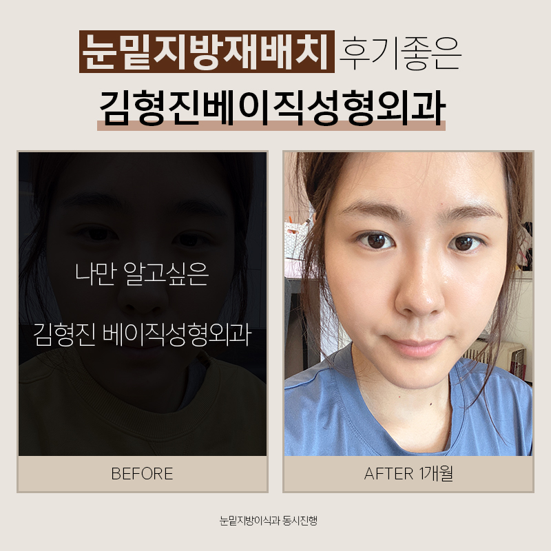 눈밑지방재배치후기 봐주실 분 관련 이미지 7