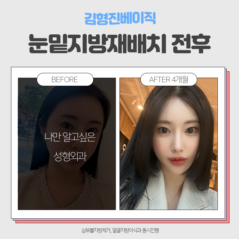 눈밑지방재배치전후 보러오실분 관련 이미지 5