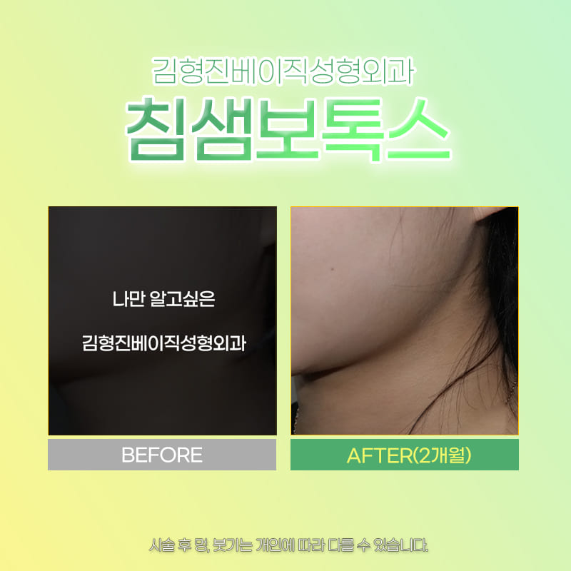턱 라인 살리는 침샘보톡스효과 궁금한 사람! 관련 이미지 6