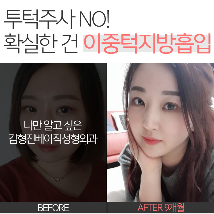 투턱주사 언제까지 맞으려구요? 관련 이미지 2