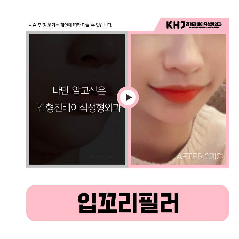 자연스럽게 올라간 미소, 입꼬리올리는시술로 완성해요 관련 이미지 6