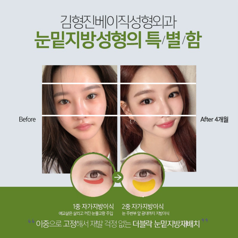 눈밑지방재배치부작용 때문에 고민 중인 분? 관련 이미지 6