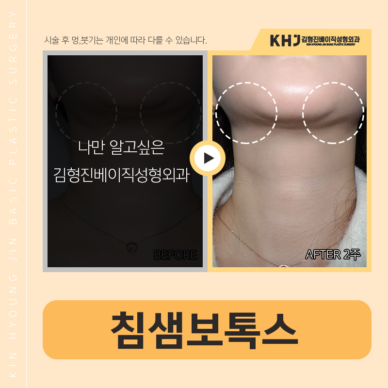 침샘비대증치료 이거 하나면 끝! 관련 이미지 4
