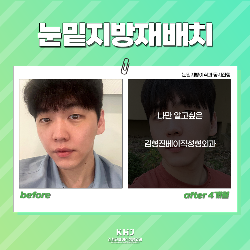 눈밑지방재배치전후 보러 오실래요~? 관련 이미지 5