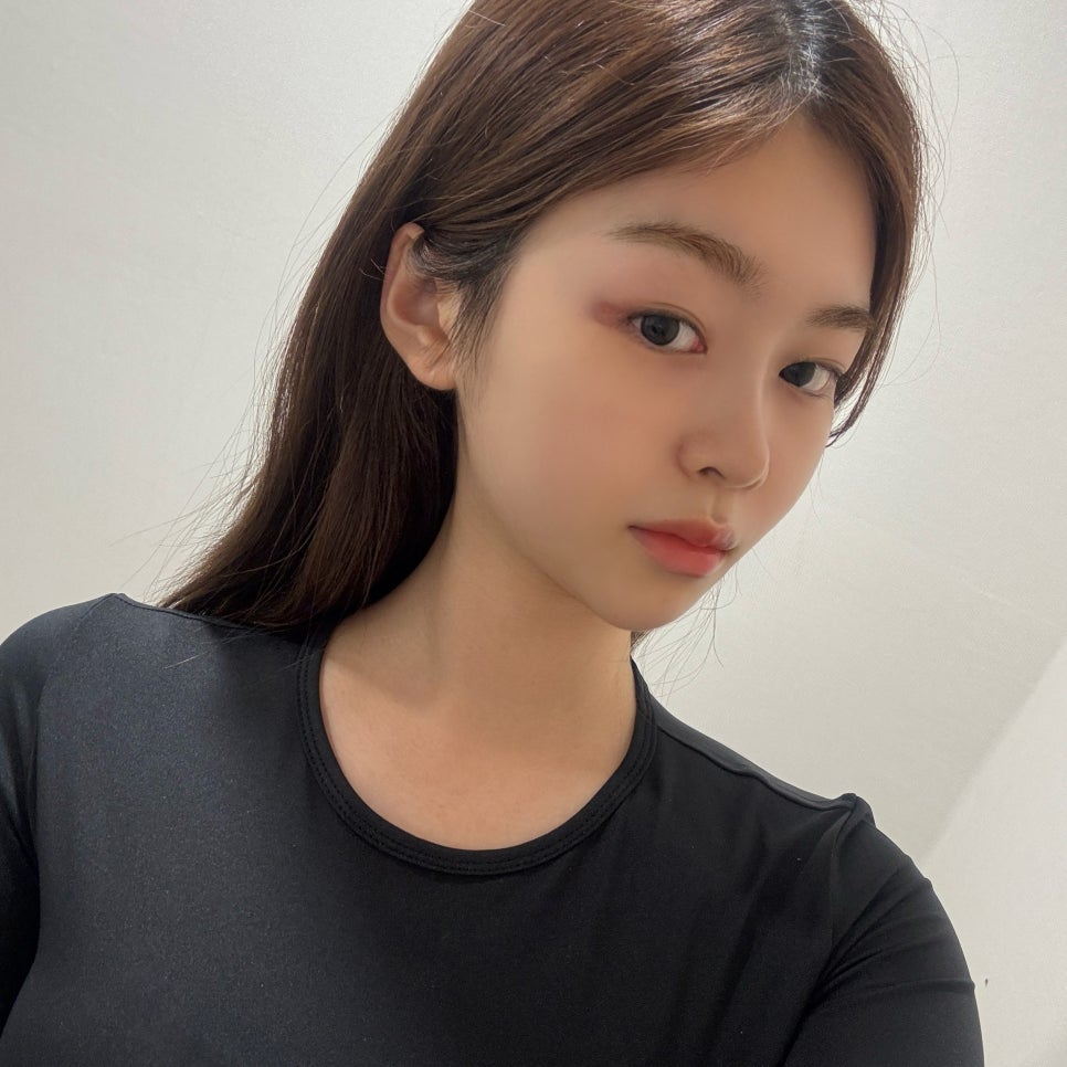 넥슬림주사전후 목부터 어깨까지 더 여리여리하게 관련 이미지 2