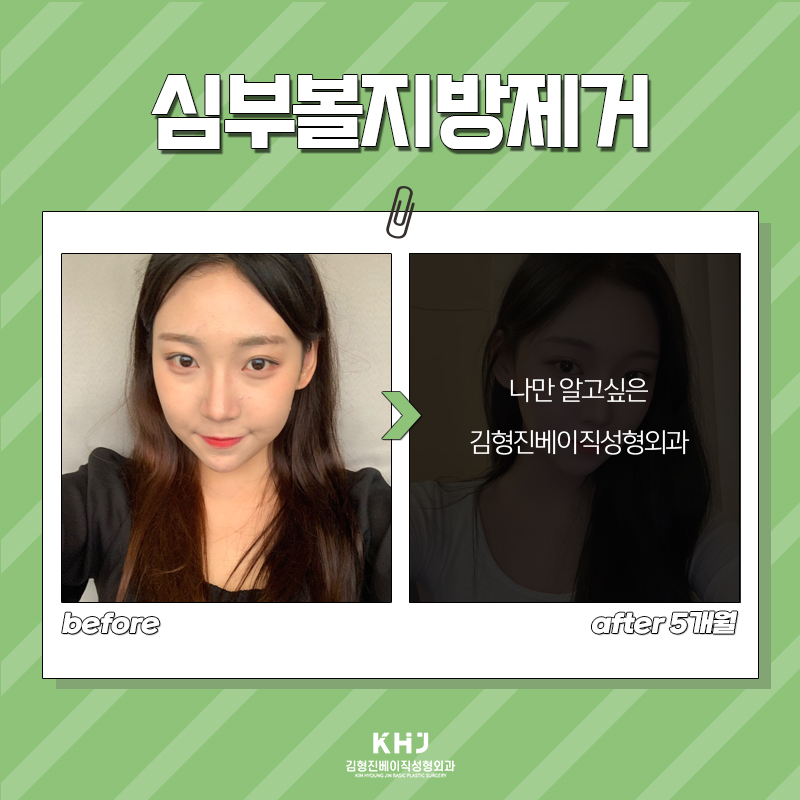 당신만 모르는 심부볼없애는법, 이 방법이 가장 빠릅니다! 관련 이미지 5