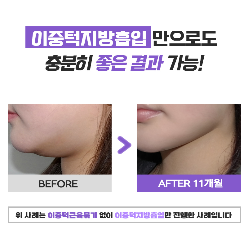 이중턱제거후기 턱선이 예뻐야 얼굴형이 예뻐요! 관련 이미지 6