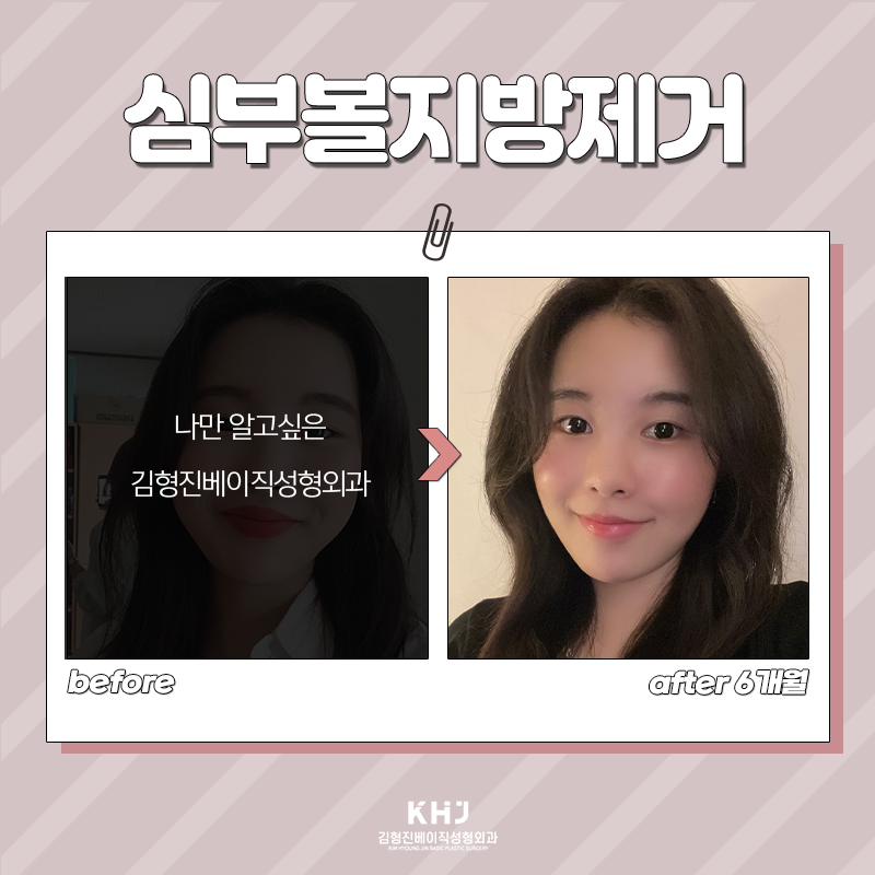 심부볼제거전후 보고 가실래요~? 관련 이미지 6