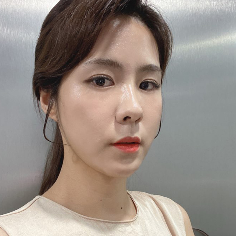 눈밑재수술 필요없는 김형진베이직 관련 이미지 3