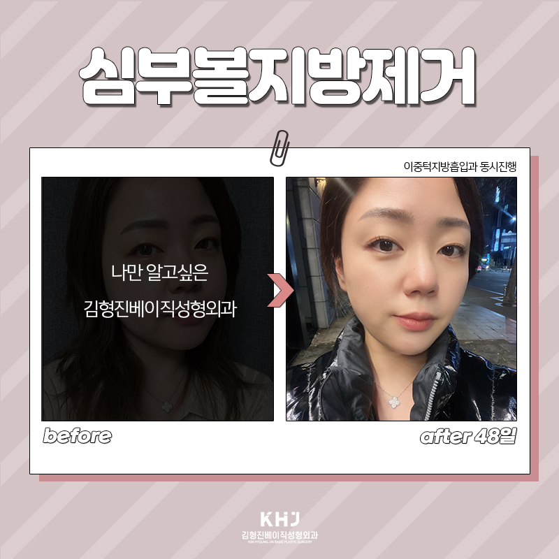 심부볼지방제거후기 궁금하셨죠? 관련 이미지 5