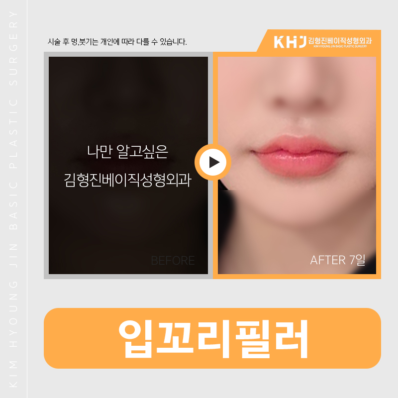 입꼬리필러통증 때문에 고민 노노 관련 이미지 3