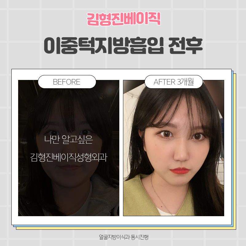 턱살흡입전후 궁금하다면 여기로! 관련 이미지 5