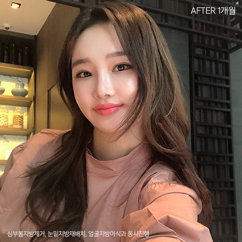 이중턱제거효과 아직 모르세요? 관련 이미지 4
