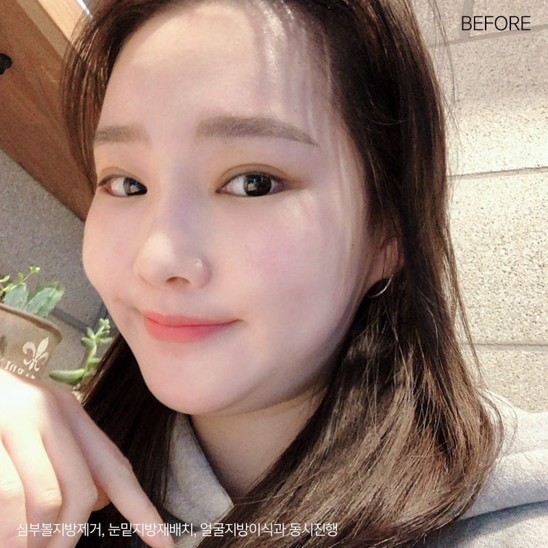 이중턱제거효과 아직 모르세요? 관련 이미지 2
