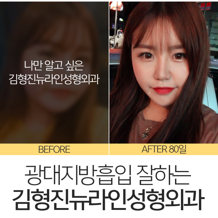 광대지방흡입 김형진뉴라인성형외과지 관련 이미지 6