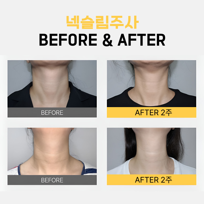 강남웨딩관리 넥슬림주사로 어깨 라인부터 목선까지 미리 관리해요! 관련 이미지 5