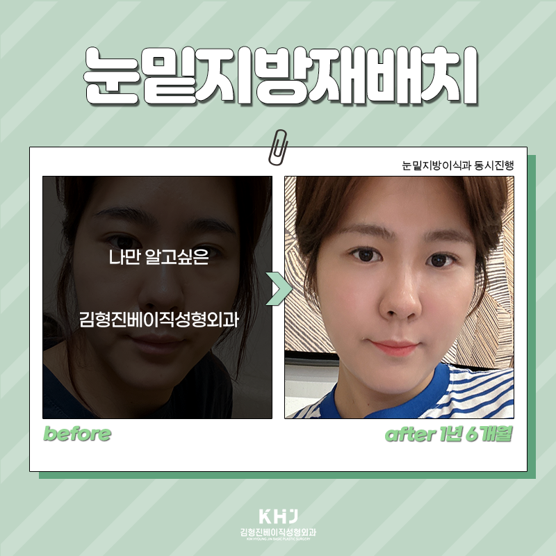 눈밑지방재배치유지력 오래가는 수술방법 찾으셨다면! 관련 이미지 3