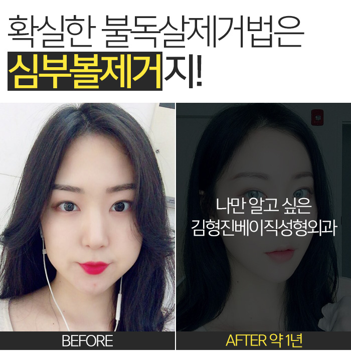 불독살 제거는 이 방법 뿐★ 관련 이미지 3