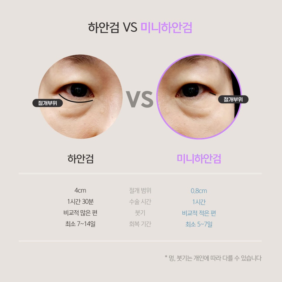 미니하안검잘하는곳에서 받아야 하는 이유 관련 이미지 4