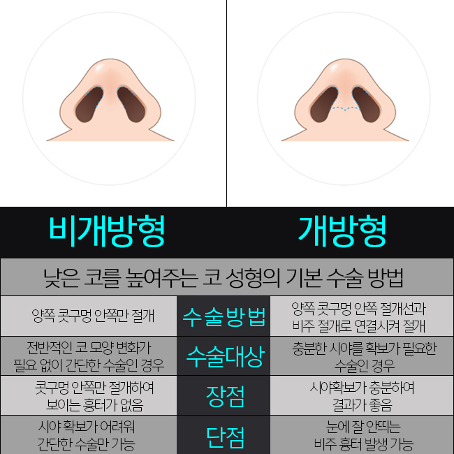 비개방코성형 개방형과 차이 알아보기! 관련 이미지 2