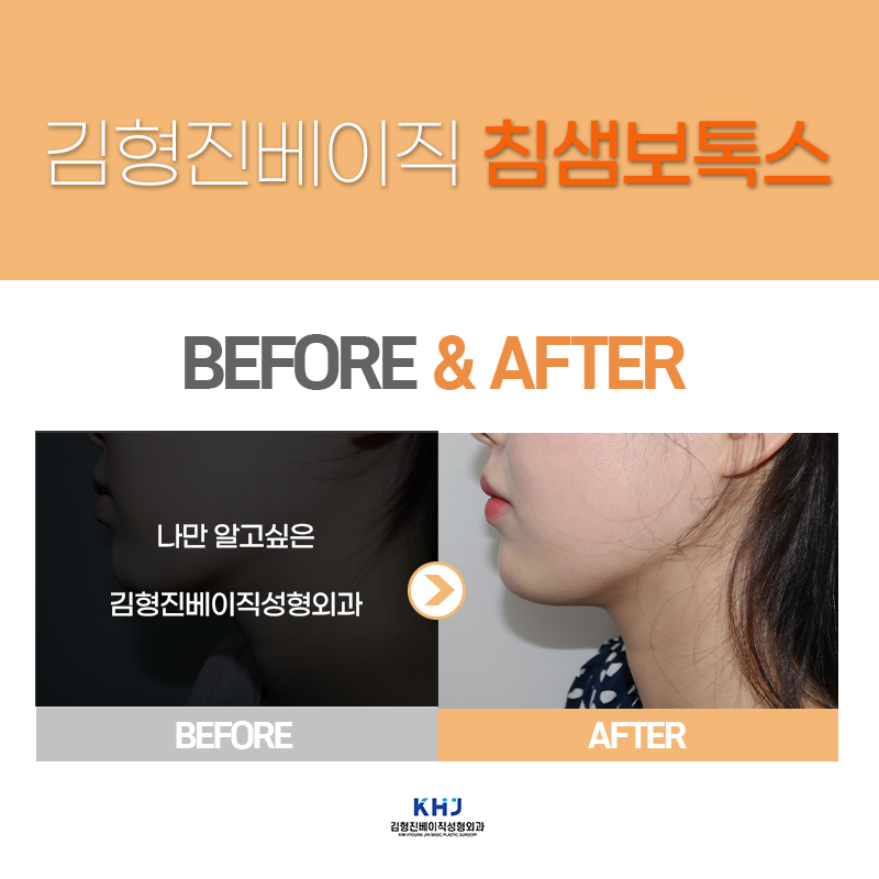 침샘보톡스시술주기 체크해야 하는 이유? 관련 이미지 4