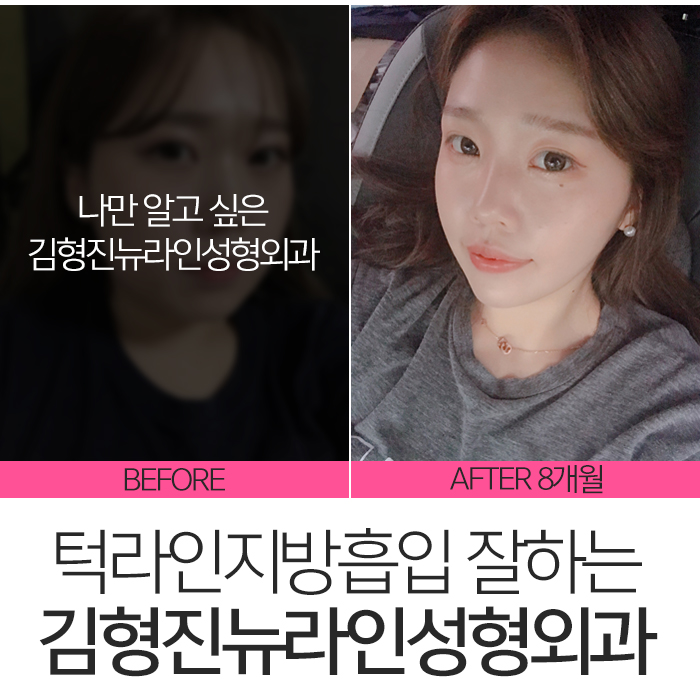 턱라인지방흡입 김형진원장이 체고야! 관련 이미지 4